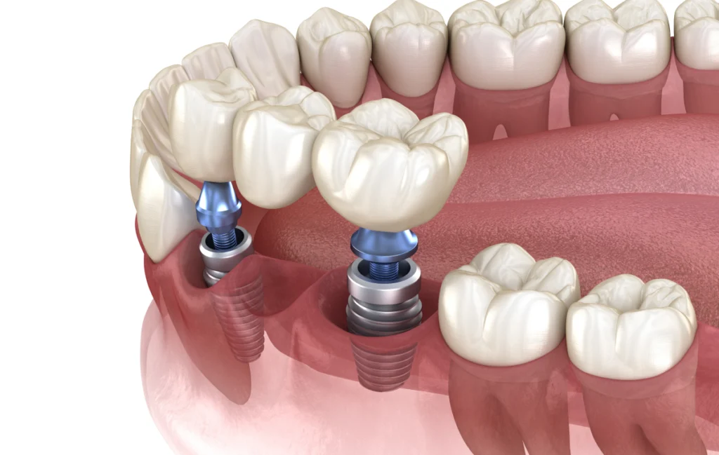 bridge implant mulhouse consultation dentiste Implants dentaires Chirurgiens-dentistes à Mulhouse
