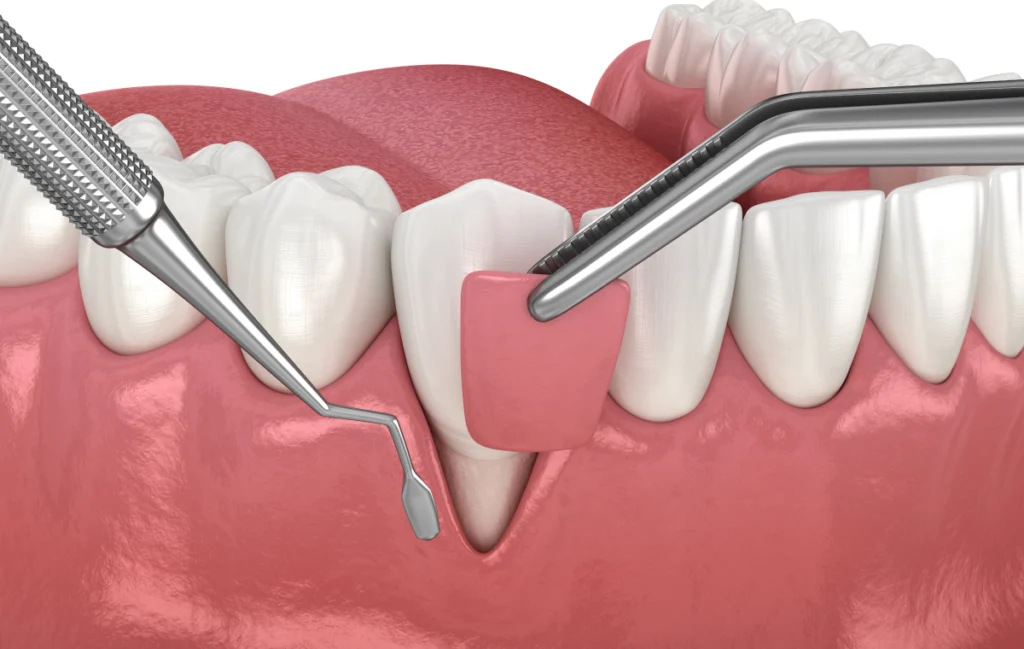 greffe gingivale mulhouse dentiste mulhouse Soins des gencives Chirurgiens-dentistes à Mulhouse