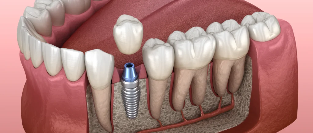 implant dentaire Implants dentaires Chirurgiens-dentistes à Mulhouse