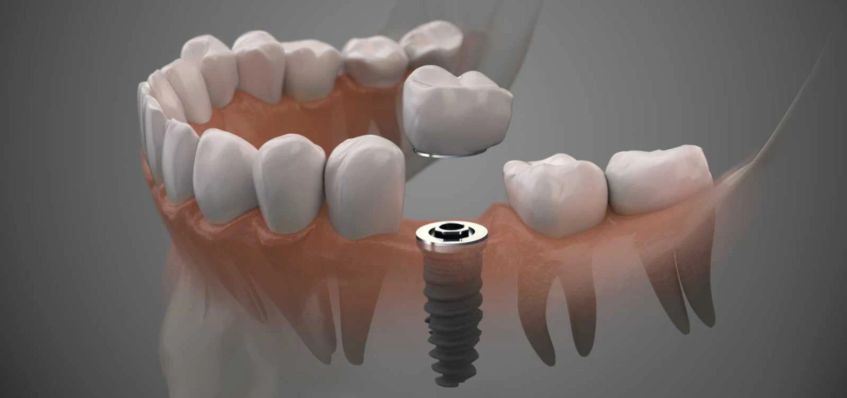 implants dentaires Implants dentaires Chirurgiens-dentistes à Mulhouse
