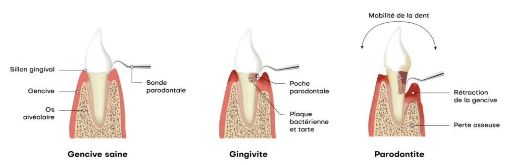 soin gencives parodontologie dentiste mulhouse La parodontite : la maladie des gencives  Chirurgiens-dentistes à Mulhouse